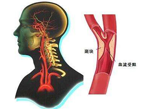 关于颈动脉斑块，你想知道的都在这里